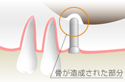 サイナスリフト